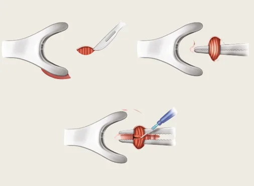 Anal Fissure consultation at Niraaya Hospital